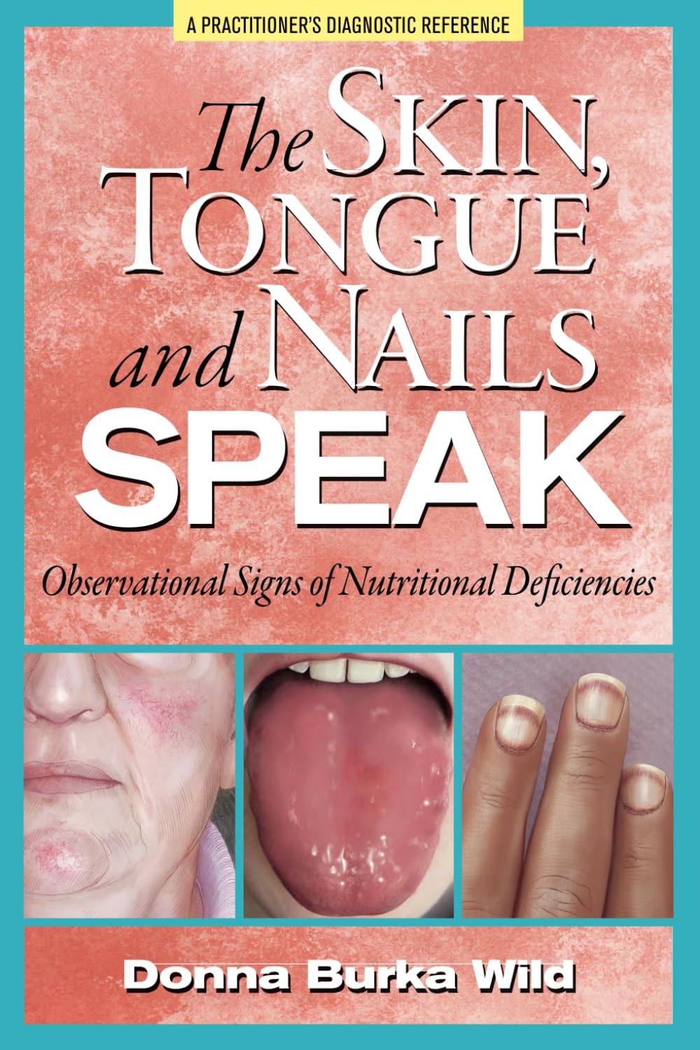 The Skin, Tongue and Nails Speak: Observational Signs of Nutritional Deficiencies - 3707